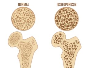 Osteoporose Indikationen und richtiges Training